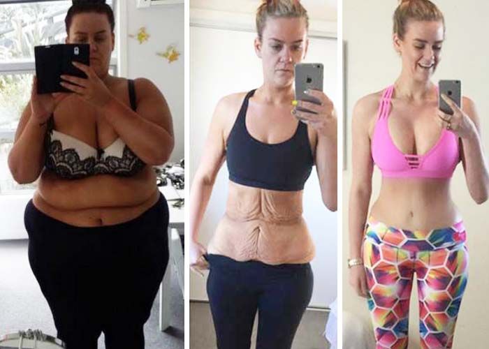 5 Best Tips To Help You Mentally Prepare For Gastric Sleeve Surgery 