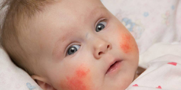 Does My Baby Have Eczema? Daily Nutrition News