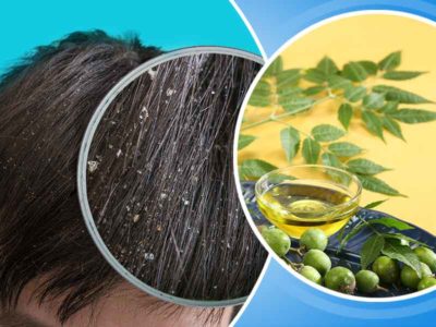 neem-oil-for-dandruff