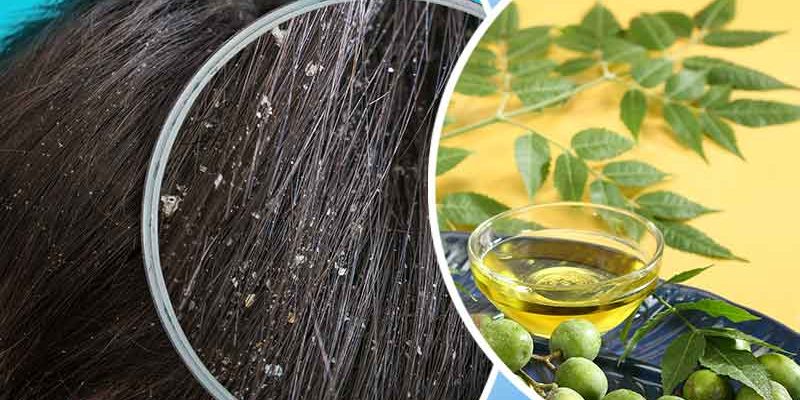 neem-oil-for-dandruff