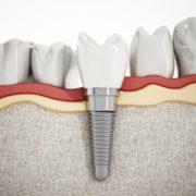 Implant Dentist Fort Lauderdale