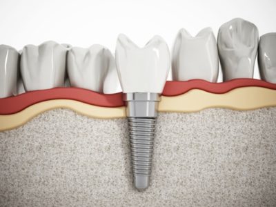 Implant Dentist Fort Lauderdale