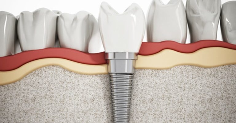 Implant Dentist Fort Lauderdale