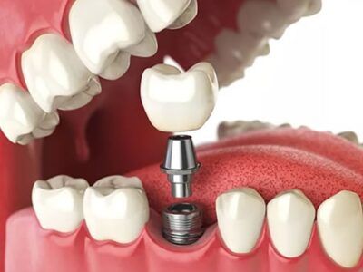 Dental Implants in Northern Rivers
