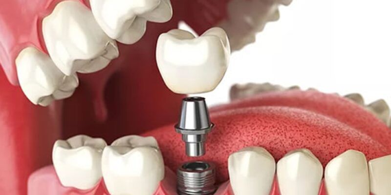 Dental Implants in Northern Rivers